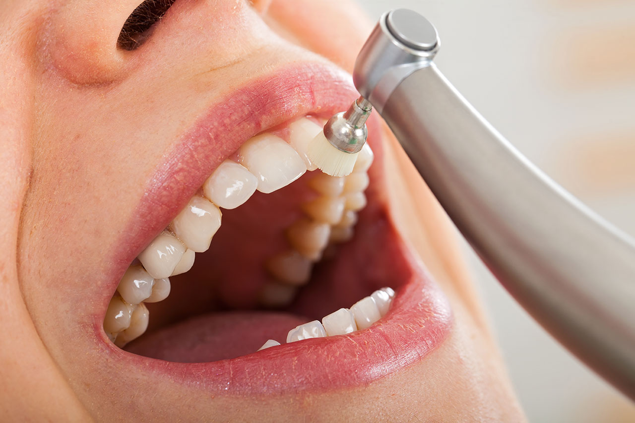 Teeth Cleaning in Fanwood, NJ: Keep Your Smile Healthy and Fresh