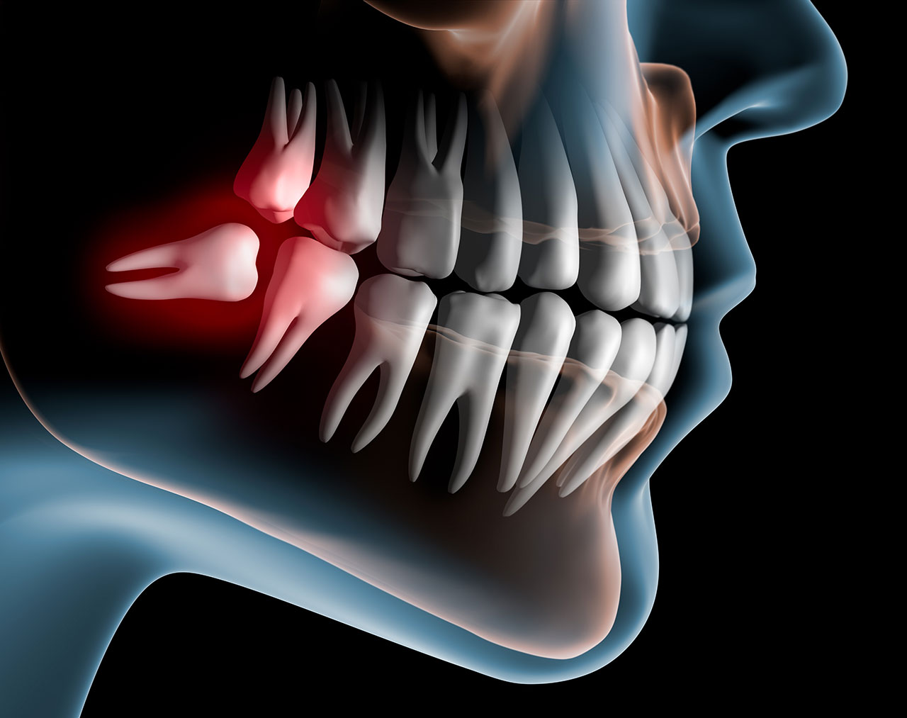 Wisdom Teeth Removal in Fanwood, NJ: Prevent Pain and Protect Your Smile